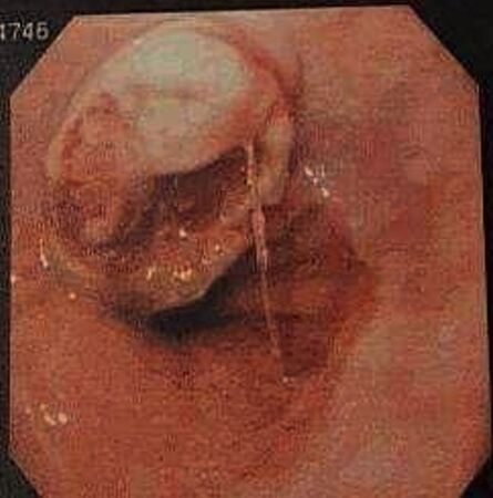 ▲▼45歲竹科工程師經檢查後診斷為食道癌。(圖/翻攝自臉書/謝義山)