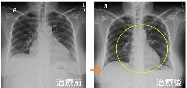 ▲水腫喘咳當更年期,婦人心臟衰竭功能慘剩3成
