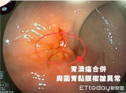 ▲▼ 胃癌 。(圖/中醫大新竹附醫提供)