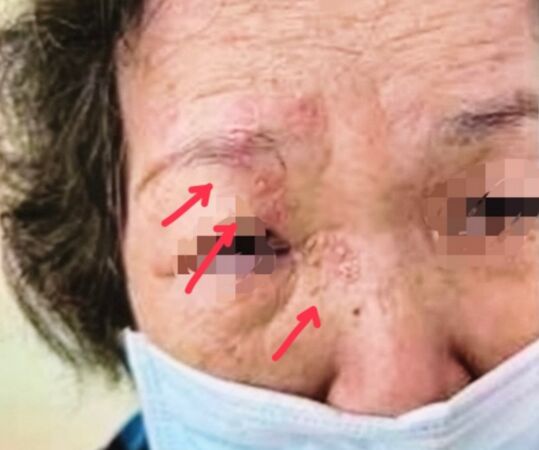 ▲婦人右眼周圍出現紅疹及水皰,經診斷為帶狀皰疹侵犯視神經引發皰疹性眼角炎。(圖/記者游瓊華翻攝)