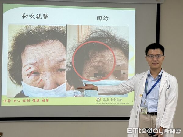 ▲婦人右眼周圍出現紅疹及水皰,經診斷為帶狀皰疹侵犯視神經引發皰疹性眼角炎。(圖/記者游瓊華翻攝)