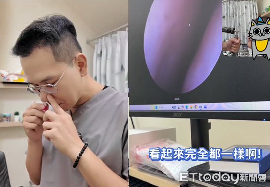 ▲▼鼻塞一吸秒通?醫實測「泰國薄荷棒」 一照內視鏡驚喊:假的啦。(圖/陳亮宇醫師授權提供,未經同意請勿任意翻攝)