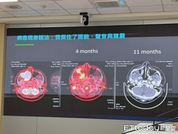 ▲▼高雄男確診晚期口腔癌,倖免切骨重建臉孔,6周消滅癌細胞。(圖/記者許宥孺攝)