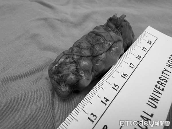 ▲▼以為是胃痛!38歲女剖出「130顆玉米狀結石」 醫示警:8成沒症狀。(圖/黃漢斌醫師授權提供,未經同意請勿任意翻攝)