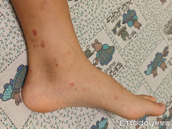 ▲小孩肚痛狂吐不是腸胃炎!醫一壓見「紅疹不退色」示警:快就醫。(圖/郭和昌醫師授權提供,未經同意請勿任意翻攝)