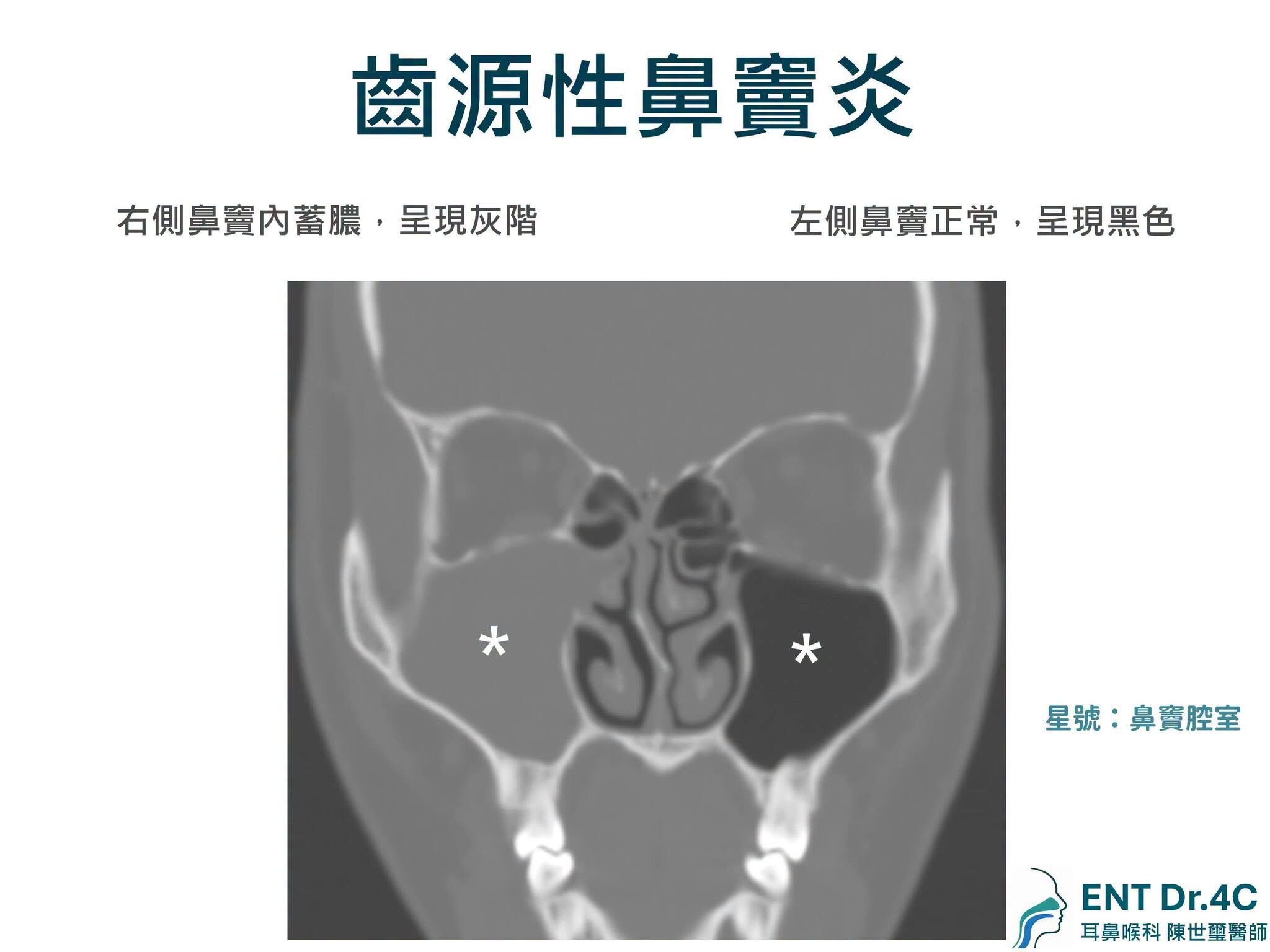 ▲齒源性鼻竇炎。(圖/陳世璽醫師授權提供,未經同意請勿任意翻攝)