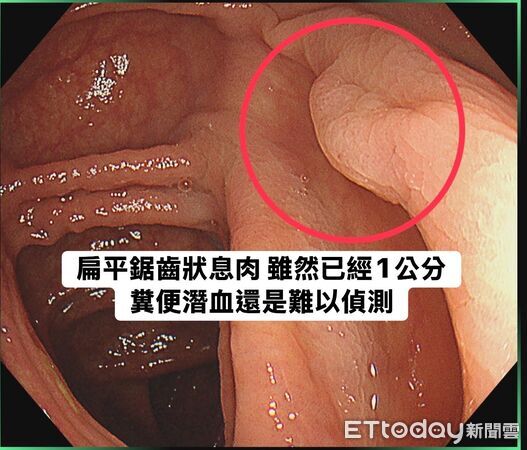 潛血正常竟滿腸息肉!醫驚「香菇、女王頭都有」:不得了。(圖/林相宏醫師授權提供)