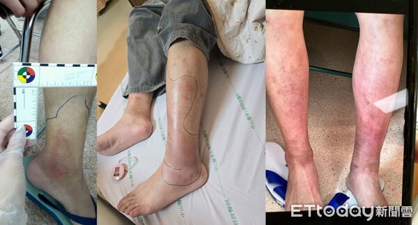 ▲25歲張先生自幼反覆感染,成年後每月住院接受免疫球蛋白治療,接受半吻合周邊血液幹細胞移植後,終於擺脫長年病痛。(圖/記者游瓊華翻攝)