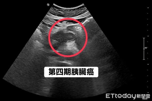 ▲ 胰臟癌「早期唯一症狀」醫示警!他胃痛瘦5kg…一照已第4期。(圖/林相宏醫師授權提供,未經同意請勿任意翻攝)