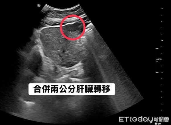 ▲ 胰臟癌「早期唯一症狀」醫示警!他胃痛瘦5kg…一照已第4期。(圖/林相宏醫師授權提供,未經同意請勿任意翻攝)