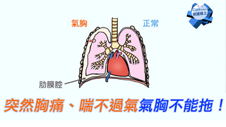 突然胸痛、喘不過氣，氣胸不能拖！