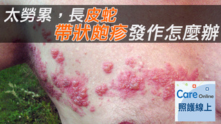 太勞累，長皮蛇，帶狀皰疹發作怎麼辦？