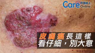 皮膚癌長這樣！看仔細，別大意