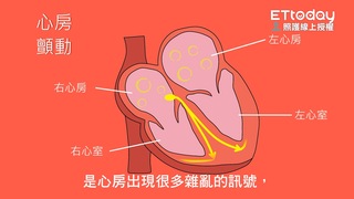 心臟亂跳要注意 避免中風找上門－心房顫動