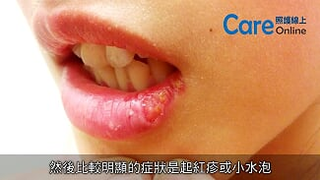 照護線上-我又沒有亂搞 為什麼會得皰疹？