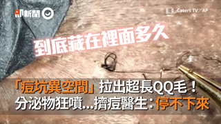 「痘坑異空間」拉出超長QQ毛！　分泌物狂噴...擠痘醫生：停不下來
