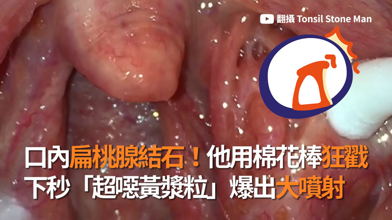 影 口內有 扁桃腺結石 他用棉花棒狂戳下秒 超噁黃漿粒 爆出大噴射 Ettoday國際新聞 Ettoday新聞雲