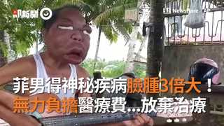菲男得神秘疾病臉腫3倍大！　無力負擔醫療費...放棄治療　