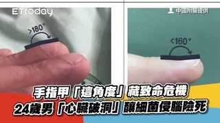 手指甲「這角度」藏致命危機　24歲男「心臟破洞」釀細菌侵腦險死