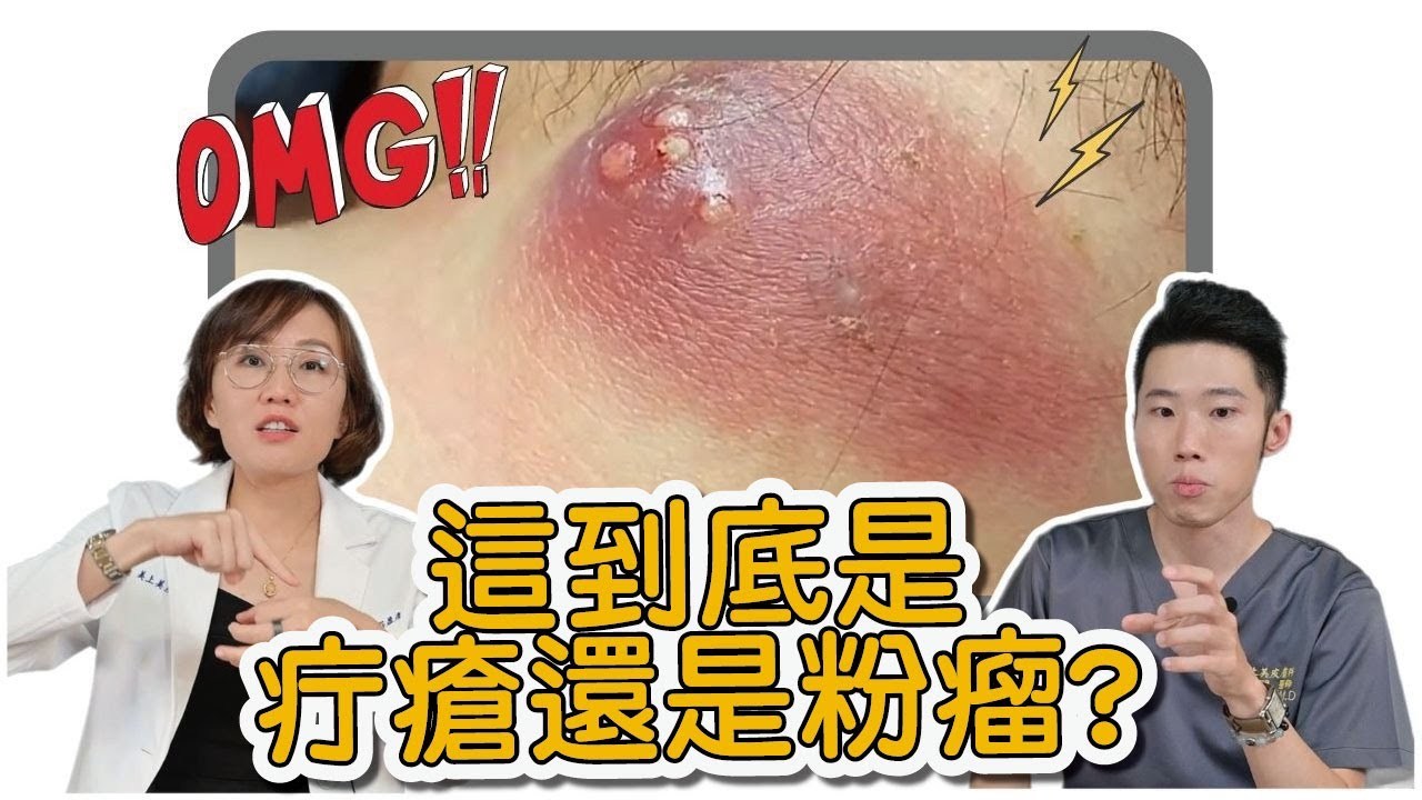 美上美皮膚保養-你有長過疔瘡嗎?疔瘡是種常見的皮膚疾病,要怎麼治療疔瘡呢? | 播吧BOBA | ETtoday新聞雲