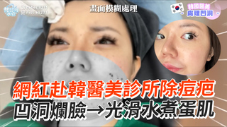 網紅赴韓醫美診所除痘疤　凹洞爛臉→光滑水煮蛋肌