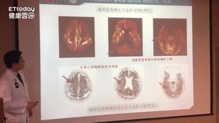 早期失智症難診斷　「葡萄糖正子造影」照出9成準確率