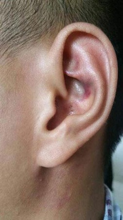 耳廓化脓性图片