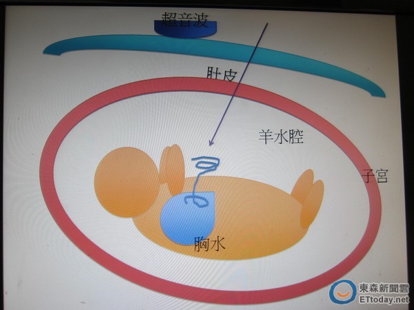 手術,隔天就明顯看出胎兒內的胸水逐漸消失,第28周積水更是完全消除