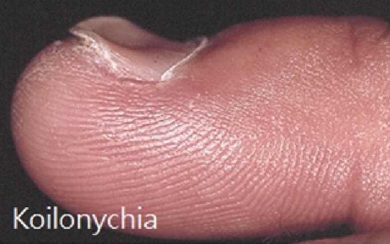 指甲變形疾病跟著來！快看這11種「指甲」你也有嗎？（圖／中醫師林欣瑩提供）