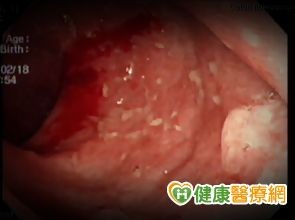 狂拉肚子又血便潰瘍性大腸炎作怪 Ettoday生活新聞 Ettoday新聞雲