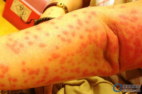 毛霉菌病症状图片图片