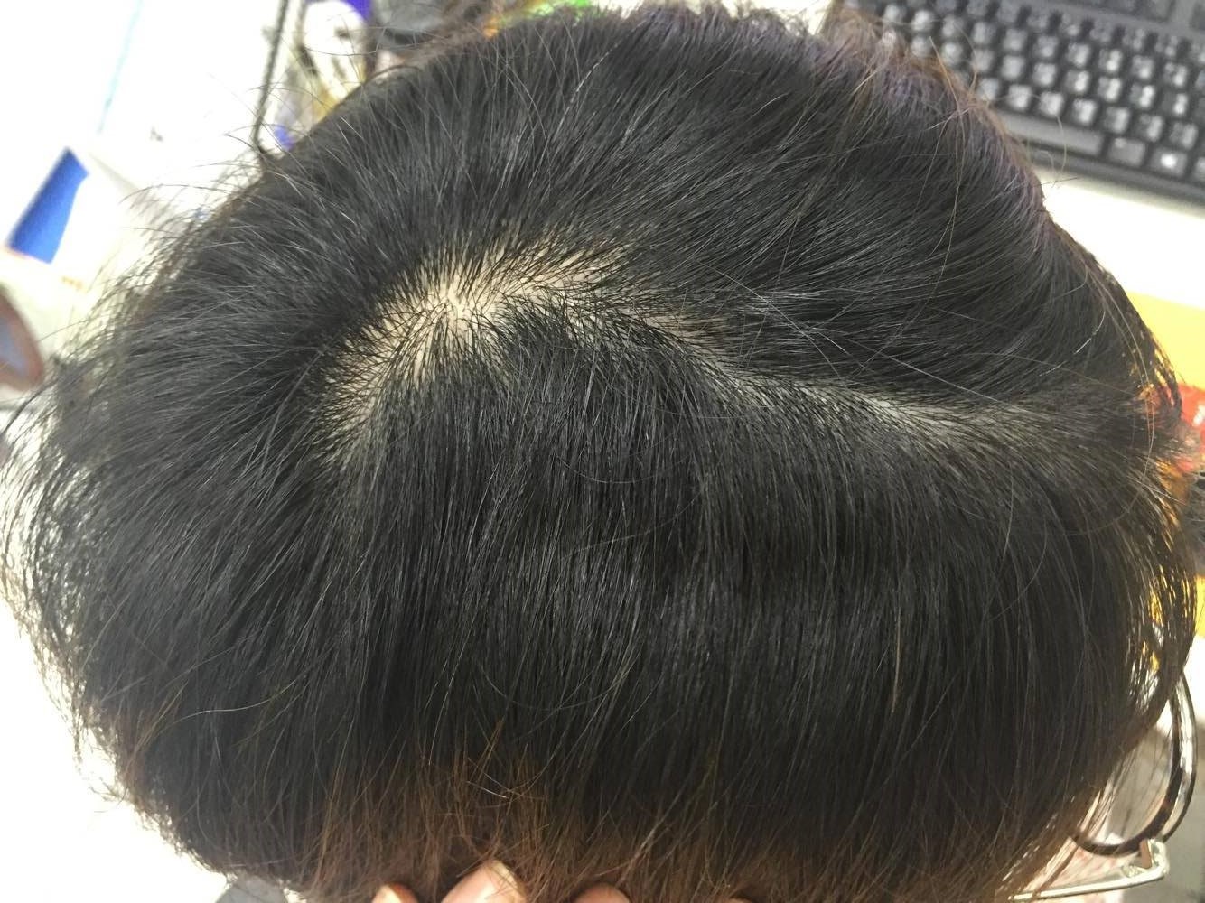 塗防曬出遊 漏頭皮 女醫髮際線曬傷 腫痛如刀割 Ettoday健康雲 Ettoday新聞雲