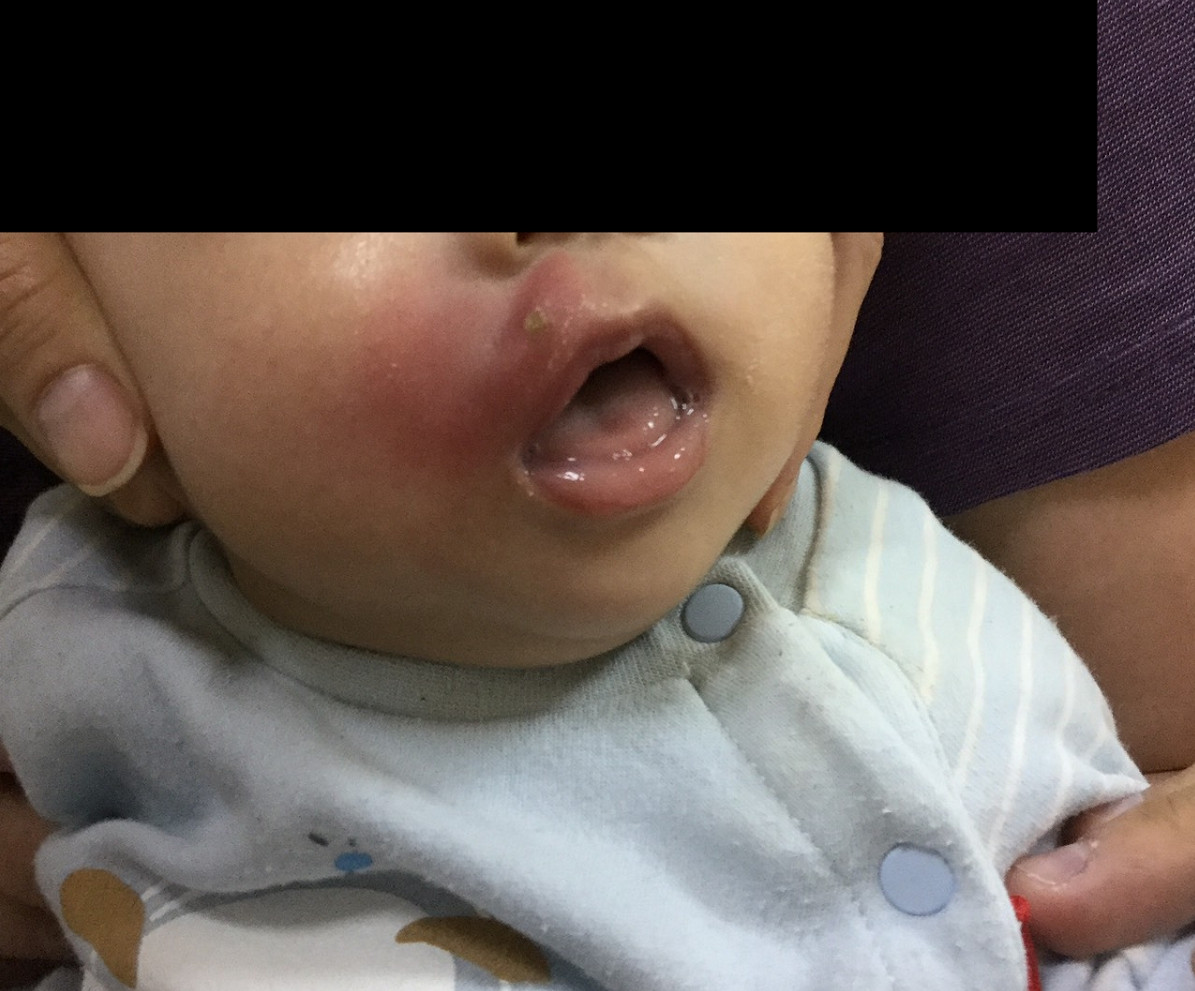 蚊叮抓破皮...嬰嘴變蜂窩性組織炎。（圖／童綜合醫院提供）