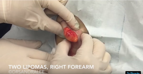 擠瘡大師自製10分鐘 精選輯 網友 看完想一看再看 Ettoday新奇新聞 Ettoday新聞雲