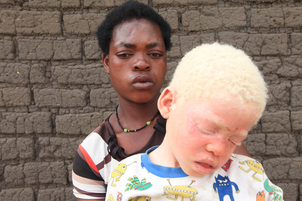 非洲部落迷信吃白化症者能治病，因此許多病童被獵殺。（圖／達志影像／美聯社）