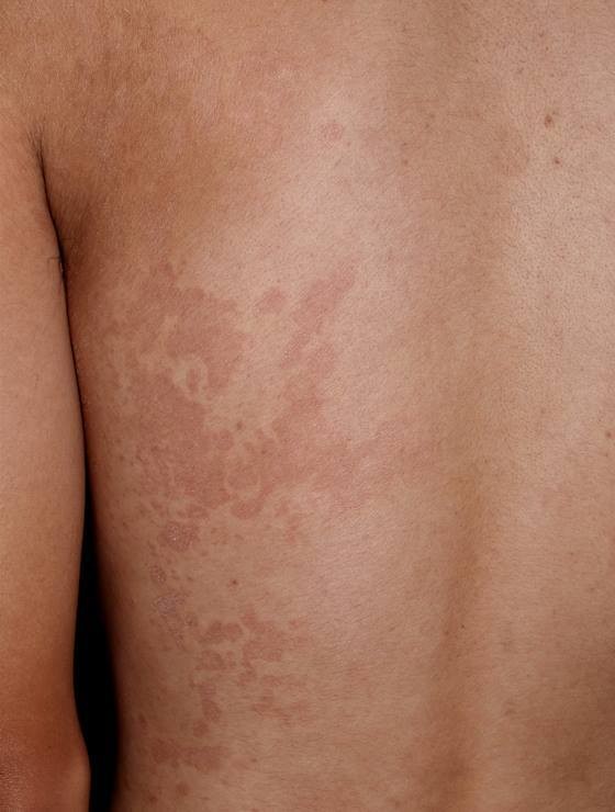 ▲門診常會看到胸、背部及手臂上出現像梅花鹿般、大小不一的紅褐色或白色斑點，平日裡幾乎沒有症狀，但流汗後可能會有癢或刺痛的感覺，這就是所謂的「汗斑。（圖／成醫提供）