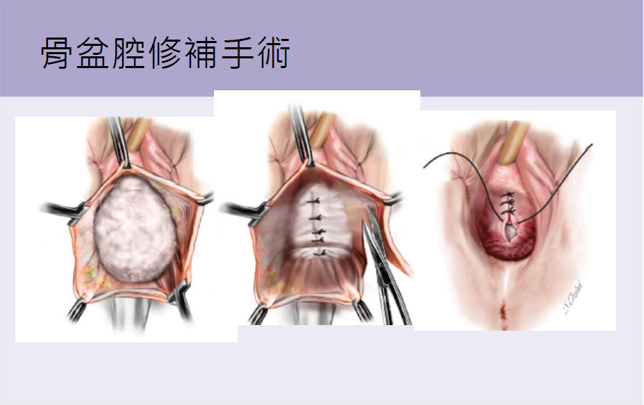 婦女骨盆腔器官脫垂生理回饋 手術改善生活品質 Ettoday健康雲 Ettoday新聞雲