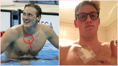 就這顆「胸痣」！粉絲鷹眼救援　奧運泳將躲過癌症危機
