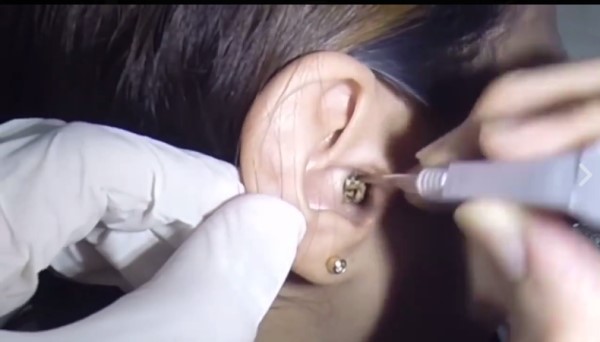 女病患的耳朵挖出了這麼多的耳屎，不少網友驚呼：她是從出生都沒挖過嗎？（圖／翻攝自臉書）