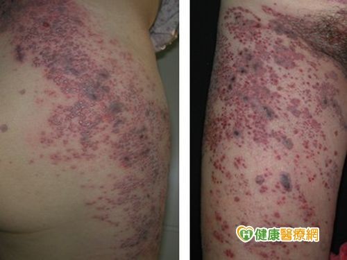 吳奇霖醫師神經科小學堂 桃園神經內科推薦 神經痛小學堂 你真的是坐骨神經痛嗎 醫師也容易忽略 尾椎帶狀皰疹