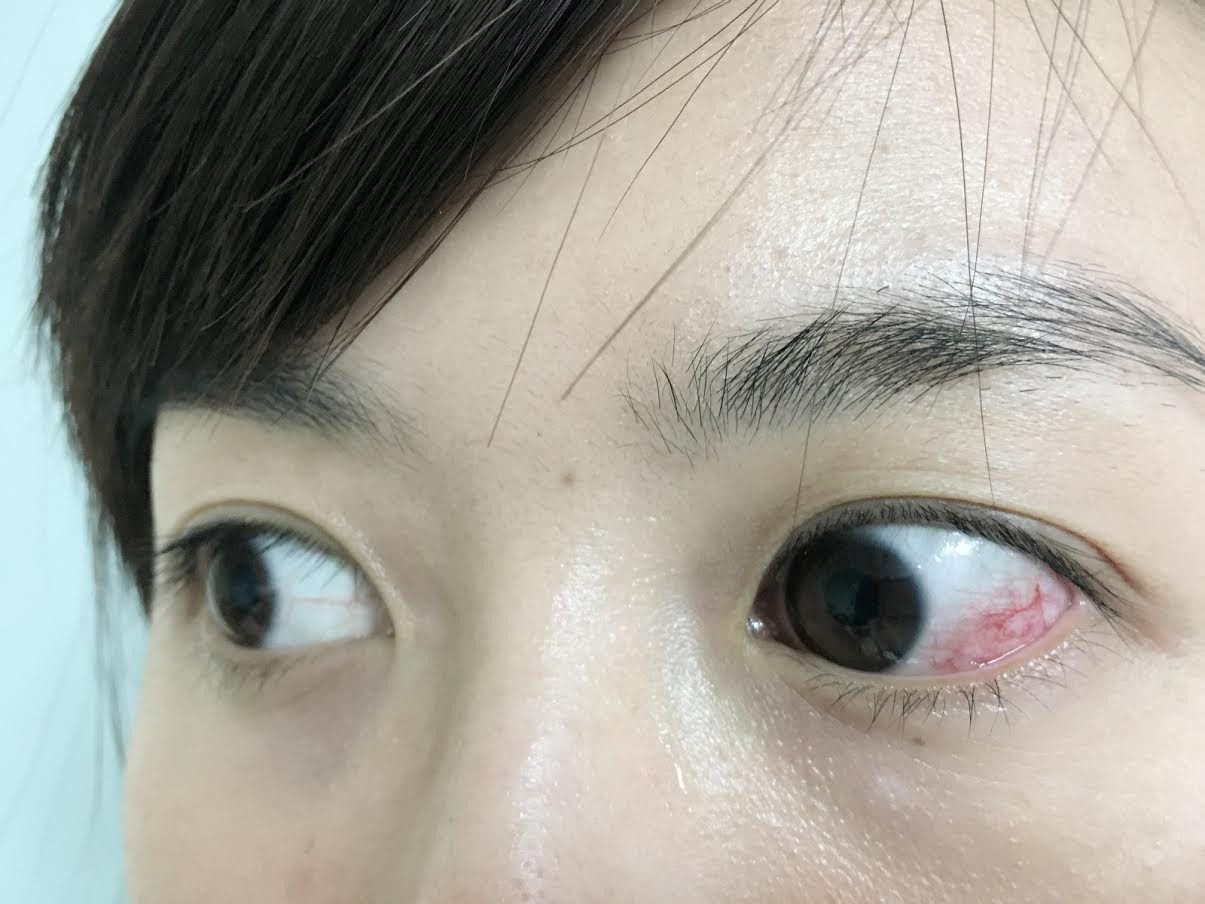 你曾經眼白突然紅一片嗎 上鞏膜炎 迄今原因仍不明 Ettoday健康雲 Ettoday新聞雲