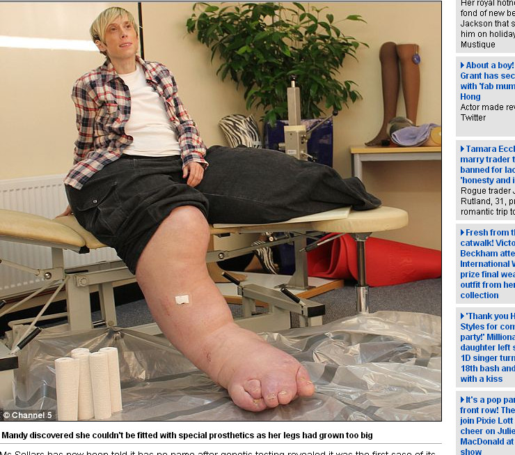 108公斤巨腿 英國38歲婦女雙腳長不停 Ettoday國際新聞 Ettoday新聞雲