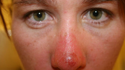12張圖讓你再也不敢說「防曬沒有很重要」　最慘的鼻子已經…