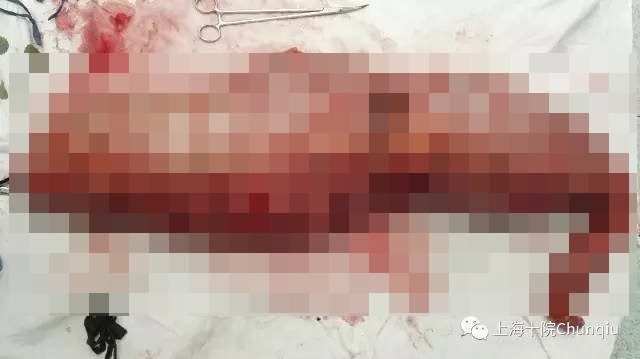 一名22歲「巨結腸」患者隆起的腹部遠大於足月產婦，只能穿一條特製的褲子「兜」住巨肚，艱難地移動腳步，經過多年折磨，他最近在上海市第十人民醫院接受手術。醫師取出從患者腹中切除重達13公斤、長達76公分的病灶，宛如科幻電影中的「異形」。（圖／翻攝「上海十院Chunqiu」）