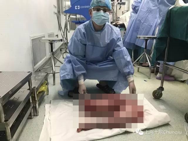 一名22歲「巨結腸」患者隆起的腹部遠大於足月產婦，只能穿一條特製的褲子「兜」住巨肚，艱難地移動腳步，經過多年折磨，他最近在上海市第十人民醫院接受手術。醫師取出從患者腹中切除重達13公斤、長達76公分的病灶，宛如科幻電影中的「異形」。（圖／翻攝「上海十院Chunqiu」）