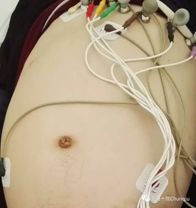 一名22歲「巨結腸」患者隆起的腹部遠大於足月產婦，只能穿一條特製的褲子「兜」住巨肚，艱難地移動腳步，經過多年折磨，他最近在上海市第十人民醫院接受手術。醫師取出從患者腹中切除重達13公斤、長達76公分的病灶，宛如科幻電影中的「異形」。（圖／翻攝「上海十院Chunqiu」）