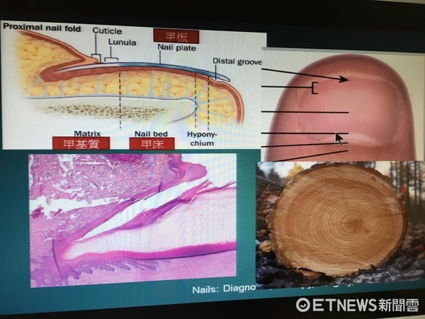 ▲指甲月牙。翻攝李勇毅醫師簡報。(圖/記者嚴云岑攝)
