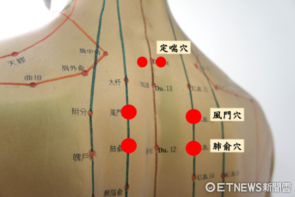 ▲「三伏貼」進行特定穴位的中藥敷貼。（圖／奇美醫院提供）