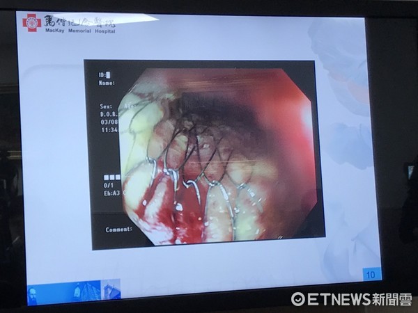 大腸支架緩解腸阻塞。（圖／記者趙于婷攝）