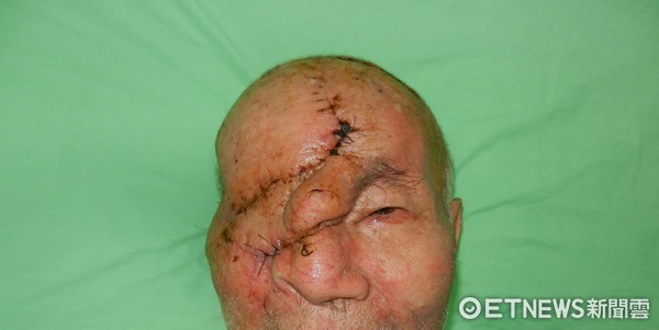 皮膚癌沒追蹤...他眼球被侵蝕潰爛。（圖／衛福部彰化醫院提供）